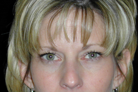 Eyelid Lift Patient 7