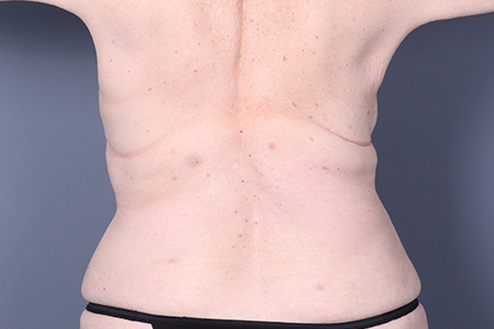 Liposuction Patient 116