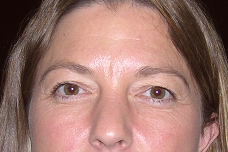 Eyelid Lift Patient 3