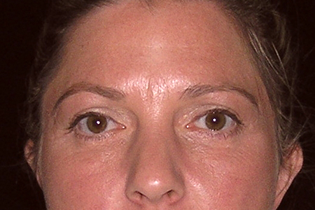 Eyelid Lift Patient 3