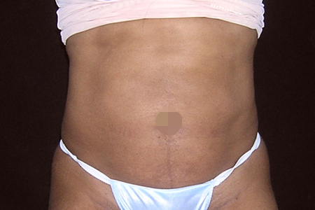 Liposuction Patient 103