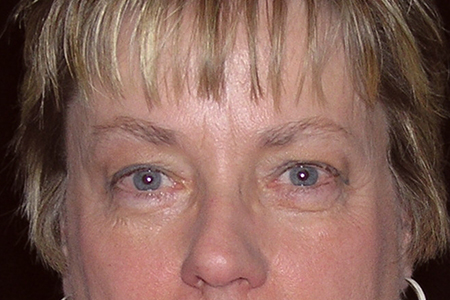 Eyelid Lift Patient 5
