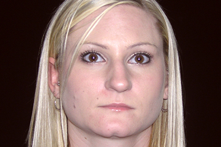 Nose Reshaping (Rhinoplasty) Patient 7