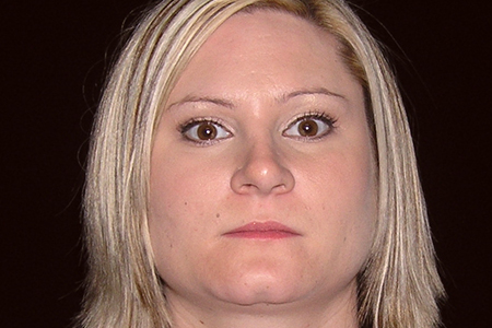 Nose Reshaping (Rhinoplasty) Patient 7