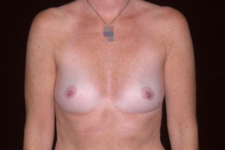 Breast Augmentation Patient 6
