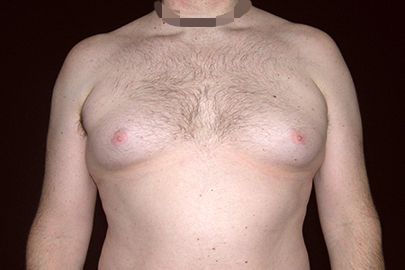 Male Breast Reduction Patient 2