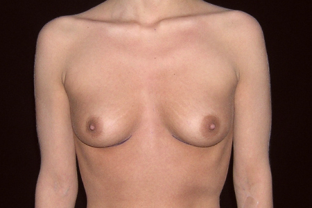 Breast Augmentation Patient 10