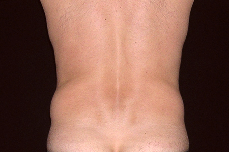 Liposuction Patient 106