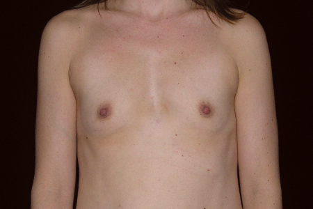 Breast Augmentation Patient 11