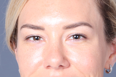 Eyelid Lift Patient 18