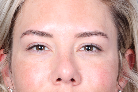 Eyelid Lift Patient 18