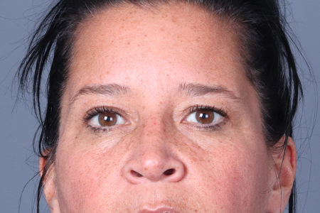 Eyebrow Lift Patient 4