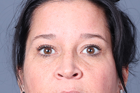 Eyebrow Lift Patient 4