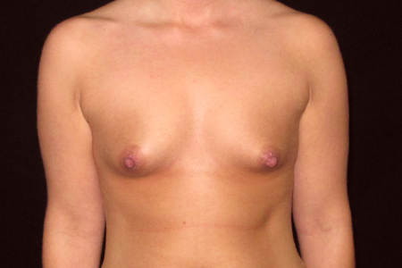 Breast Augmentation Patient 3
