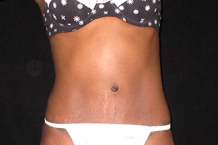 Tummy Tuck Patient 7