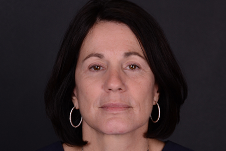 Facelift and Laser Skin Resurfacing Patient 10