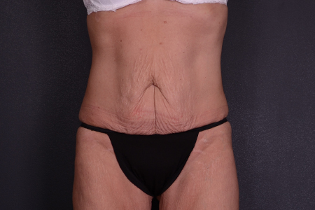 Tummy Tuck Patient 93