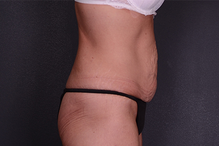 Tummy Tuck Patient 93
