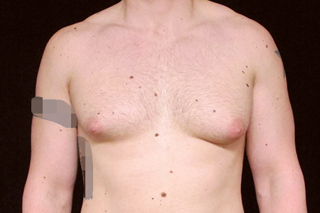 Male Breast Reduction Patient 3