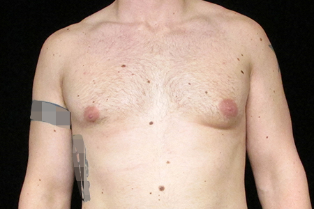 Male Breast Reduction Patient 3