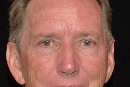 Eyelid Lift Patient 2