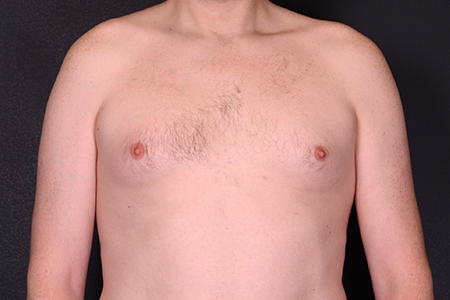Male Breast Reduction Patient 4