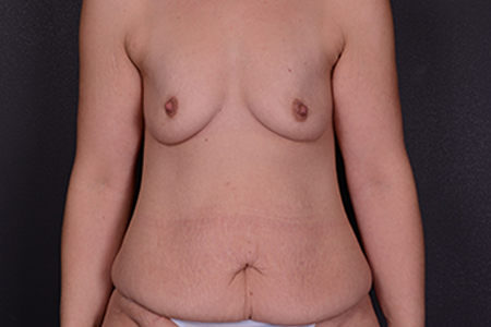 Mommy Makeover Patient 30
