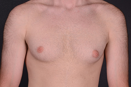 Male Breast Reduction Patient 5