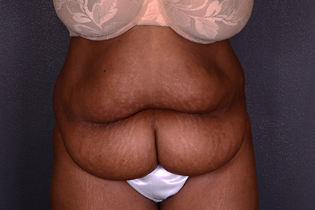 Tummy Tuck Patient 42