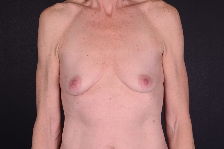 Breast Augmentation Patient 52