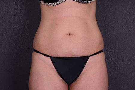 Breast Lift (with Augmentation) Patient 29