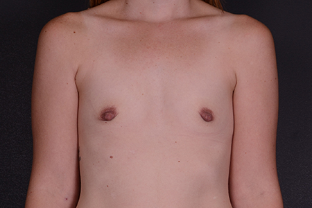 Breast Augmentation Patient 84