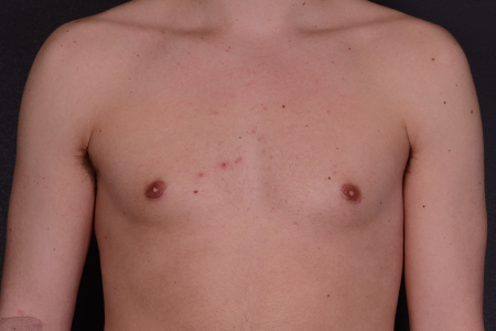 Male Breast Reduction Patient 8