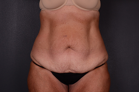 Tummy Tuck Patient 108