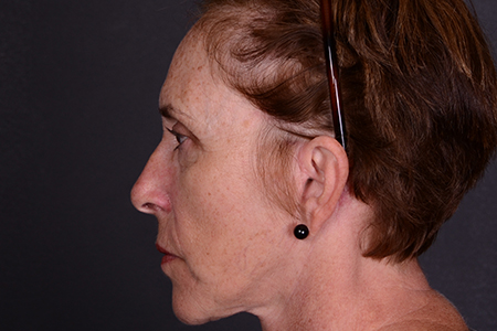 Facelift and Laser Skin Resurfacing Patient 19