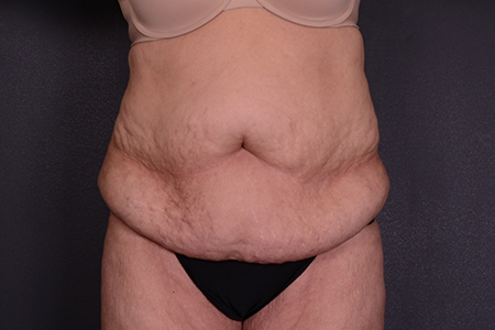 Tummy Tuck Patient 81
