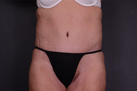 Tummy Tuck Patient 81