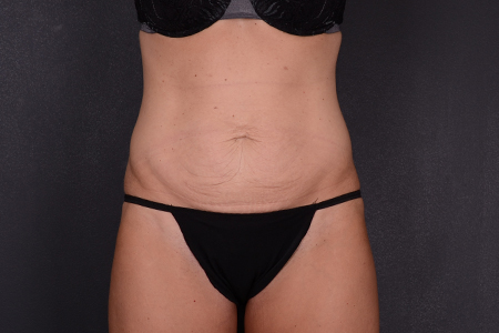 Tummy Tuck Patient 102