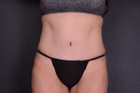 Tummy Tuck Patient 92