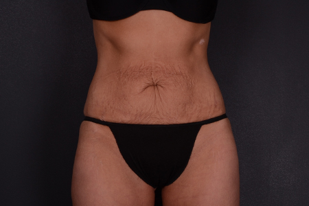 Tummy Tuck Patient 104
