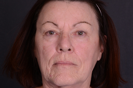 Facelift, Eyelid Lift, and Laser Skin Resurfacing Patient 20