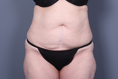 Tummy Tuck Patient 125