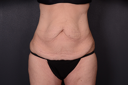 Tummy Tuck Patient 99