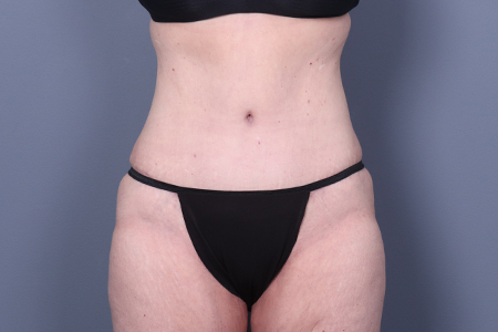 Tummy Tuck Patient 99