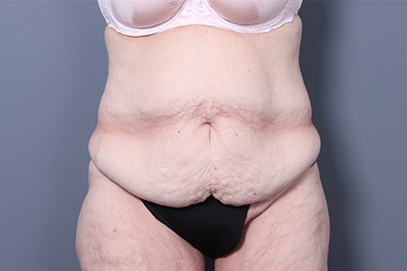 Tummy Tuck Patient 121