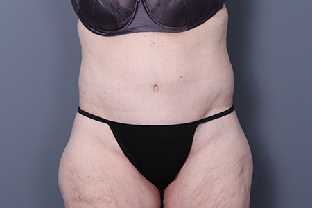 Tummy Tuck Patient 121