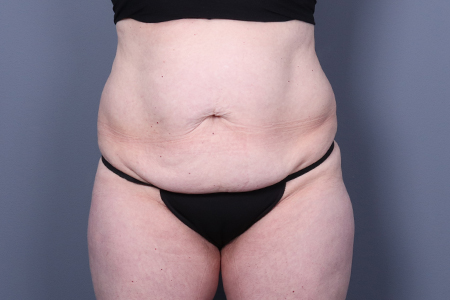 Tummy Tuck Patient 109