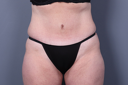 Tummy Tuck Patient 109