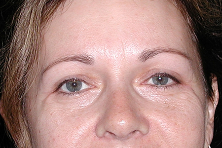 Eyebrow Lift and Eyelid Lift Patient 2