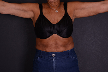 Arm Lift Patient 14